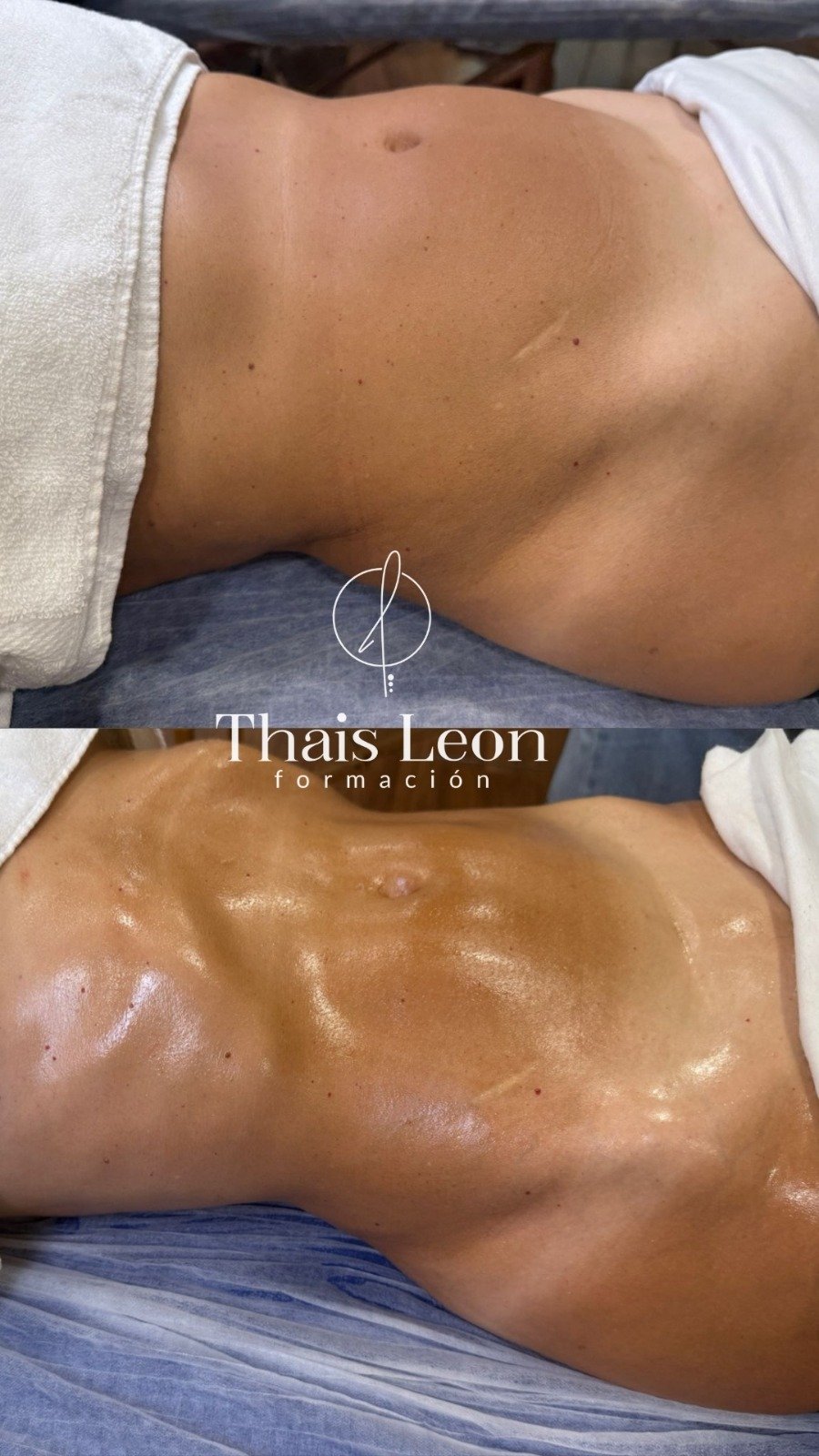 Drenaje método Thais leon