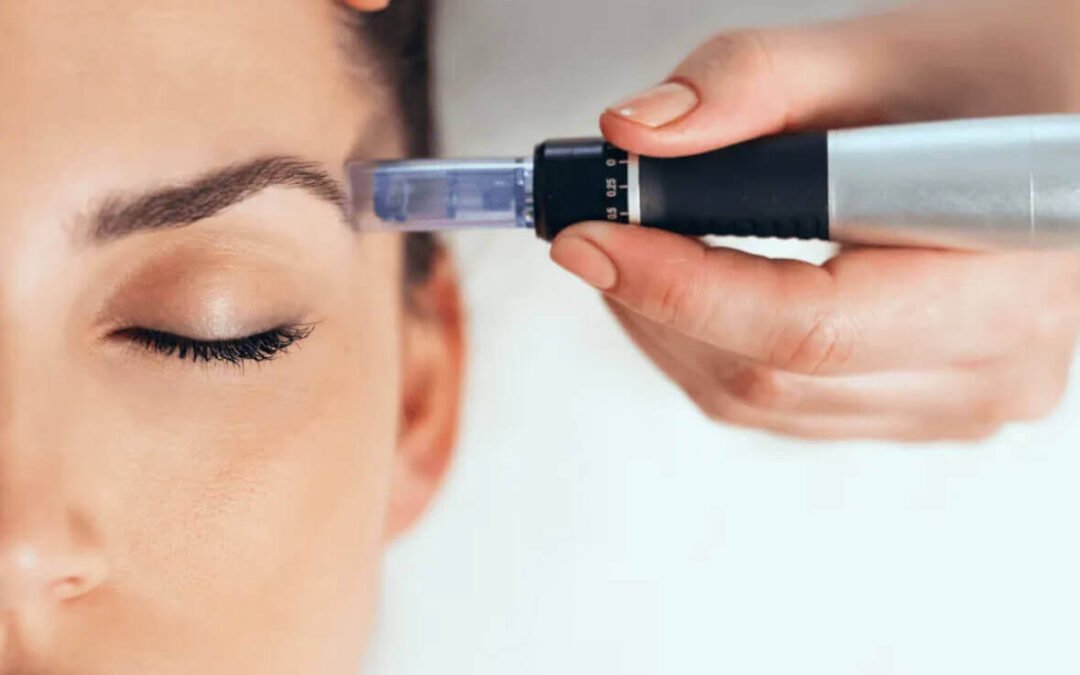 Dermapen en Tarragona: guía completa sobre qué es, cómo funciona y qué resultados esperar